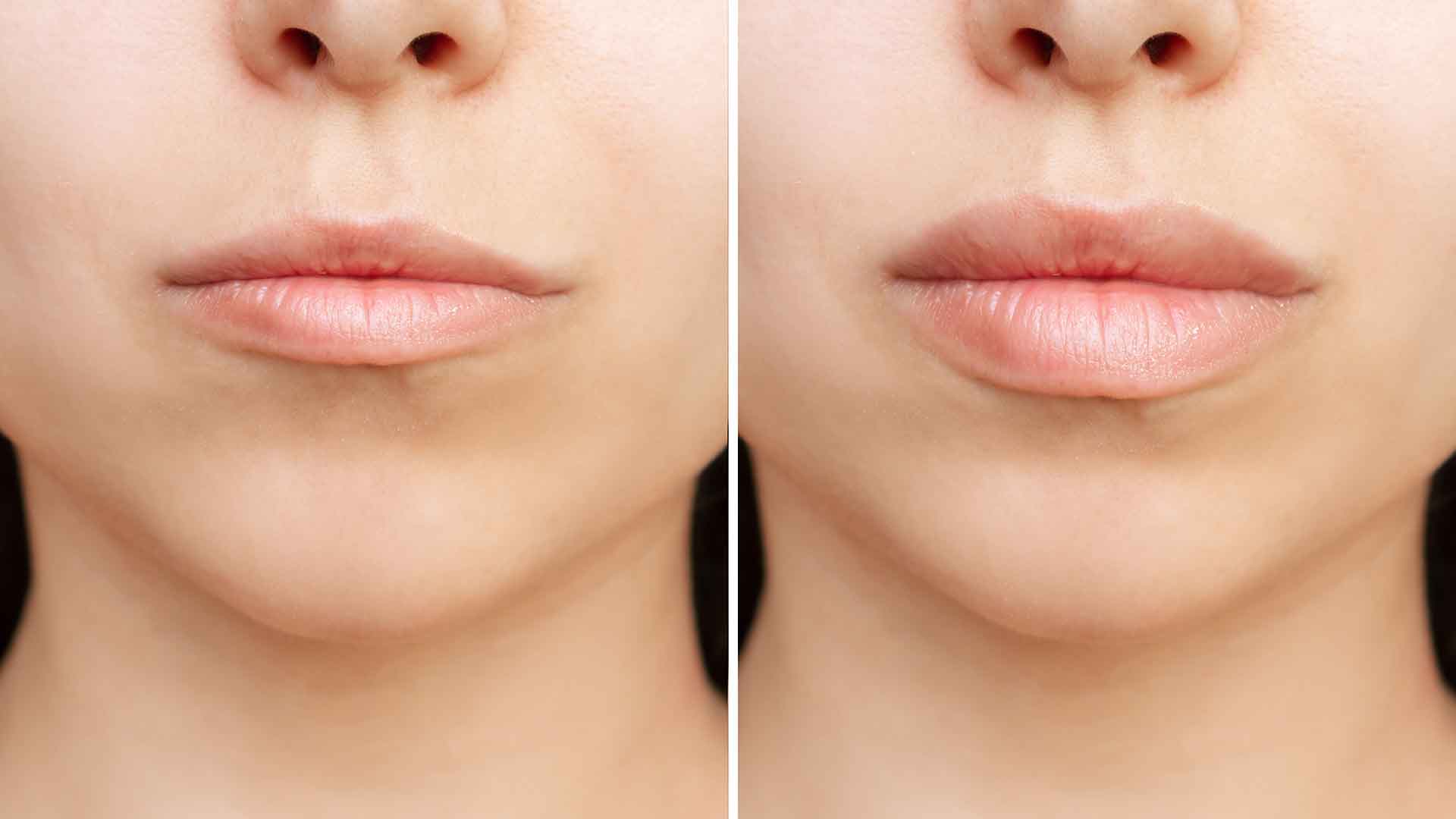 Lippenaufpolsterung - Perfect Lips